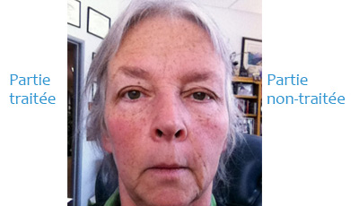 Soins anti-âge avec le miHealth